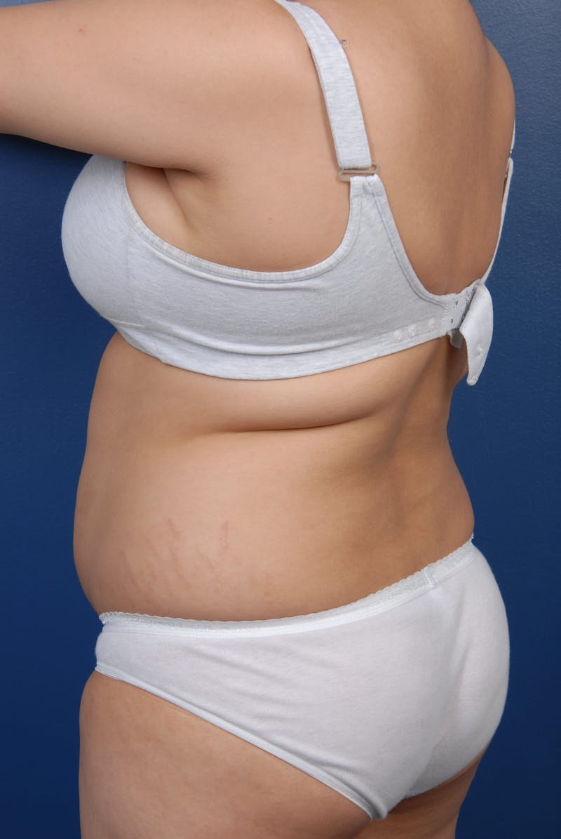 Liposuction Before & After Gallery - Patient 67102340 - Image 7