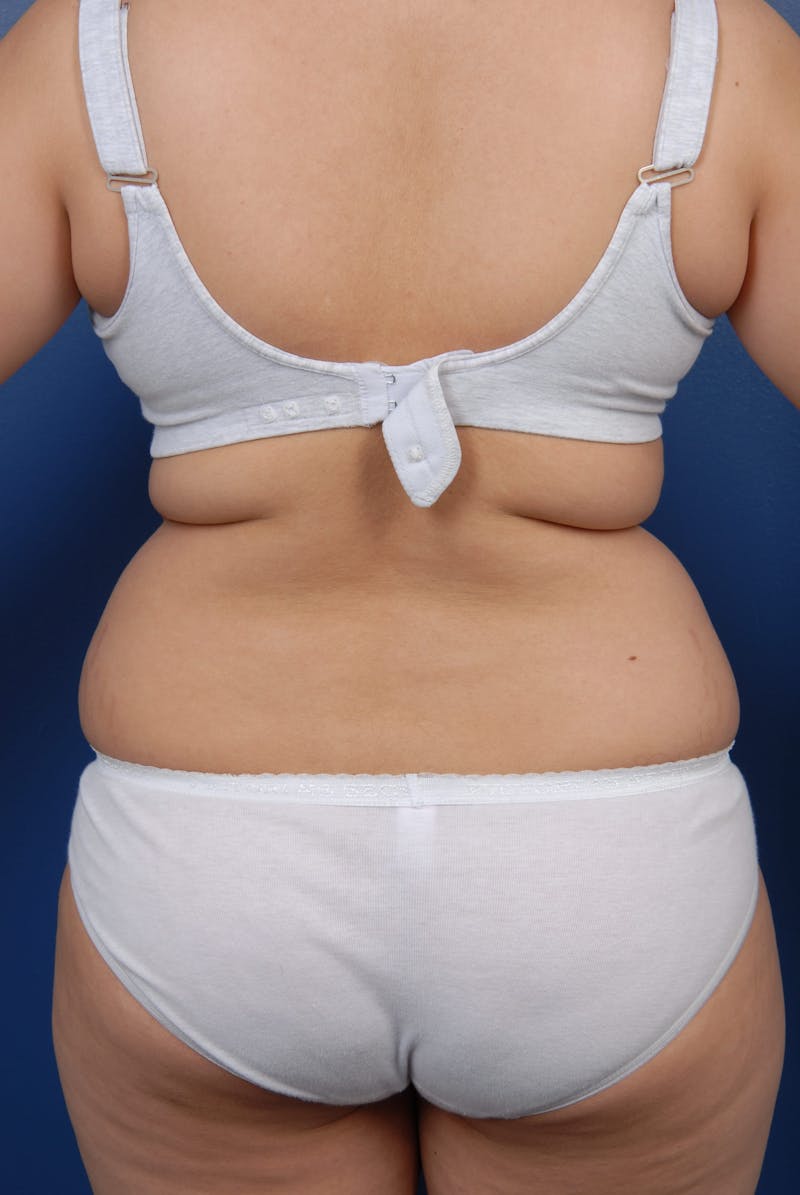 Liposuction Before & After Gallery - Patient 67102340 - Image 9