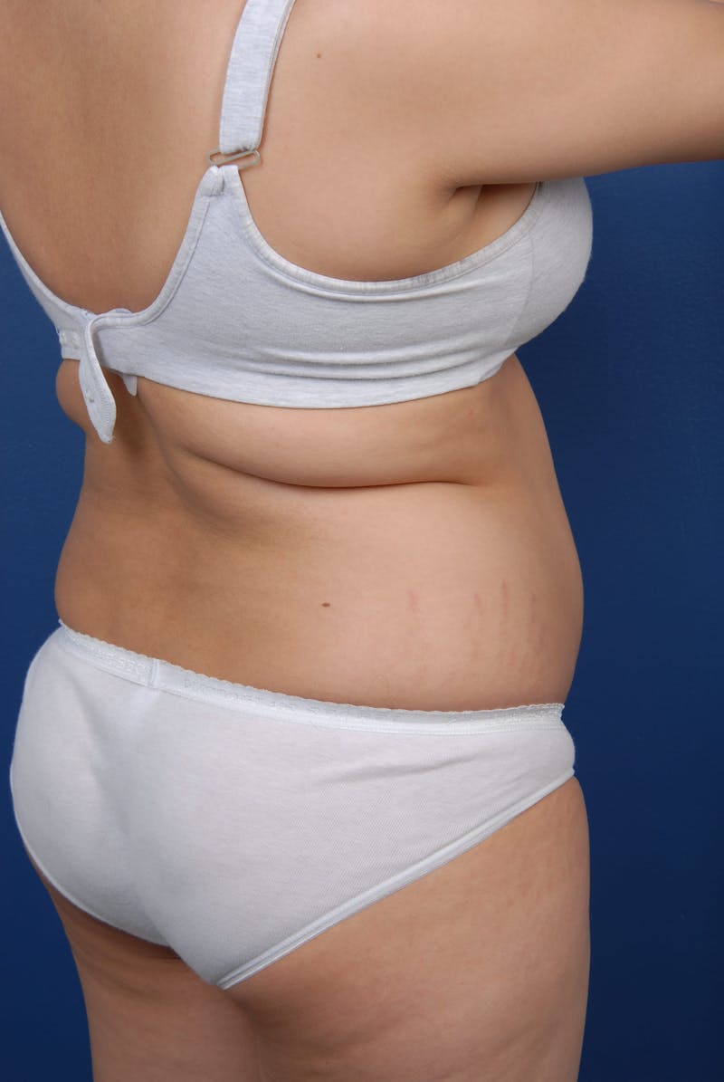 Liposuction Before & After Gallery - Patient 67102340 - Image 11