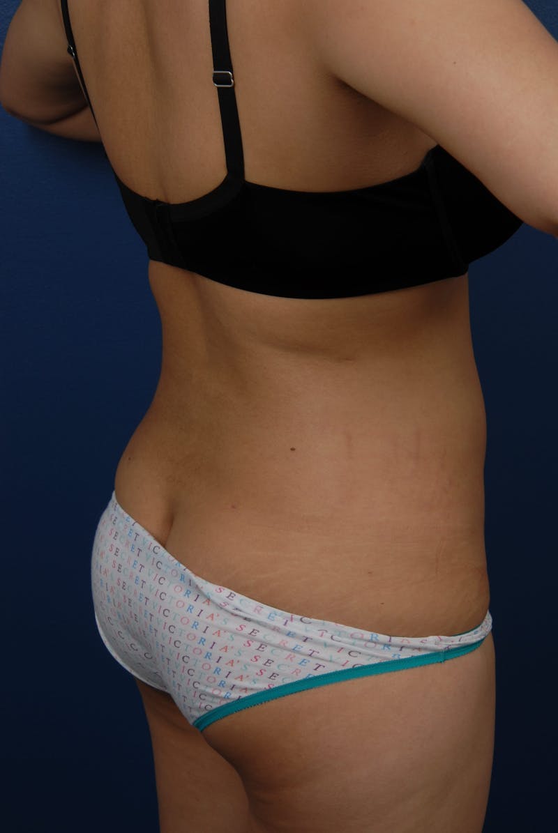 Liposuction Before & After Gallery - Patient 67102340 - Image 12