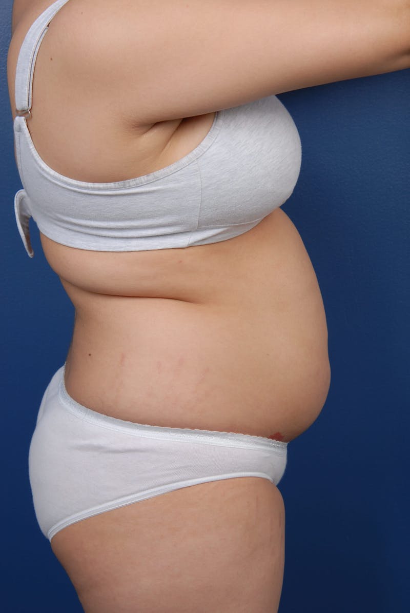 Liposuction Before & After Gallery - Patient 67102340 - Image 13