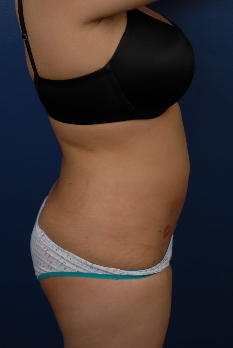 Liposuction Before & After Gallery - Patient 67102340 - Image 14