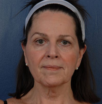 Facelift Before & After Gallery - Patient 67109688 - Image 1
