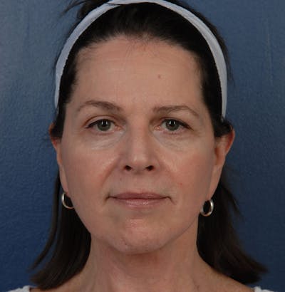 Facelift Before & After Gallery - Patient 67109688 - Image 2