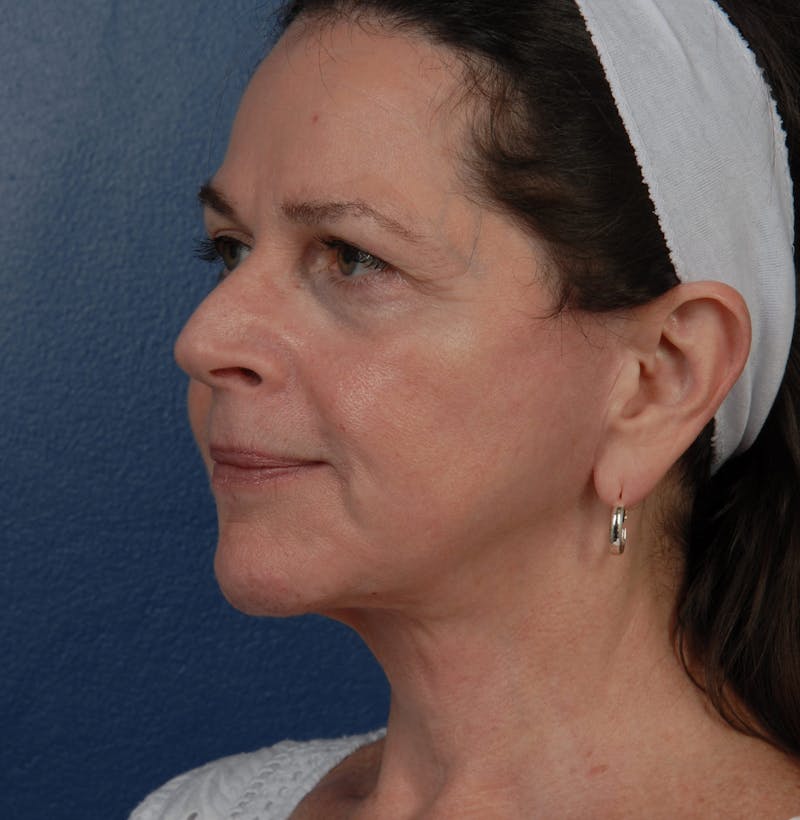 Facelift Before & After Gallery - Patient 67109688 - Image 4