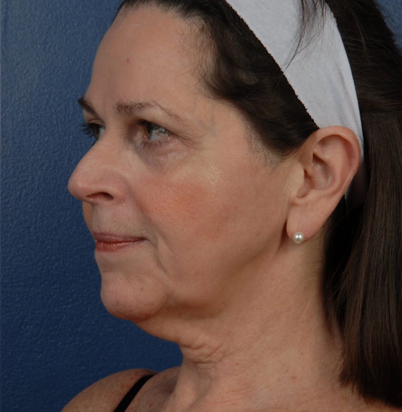 Facelift Before & After Gallery - Patient 67109688 - Image 3
