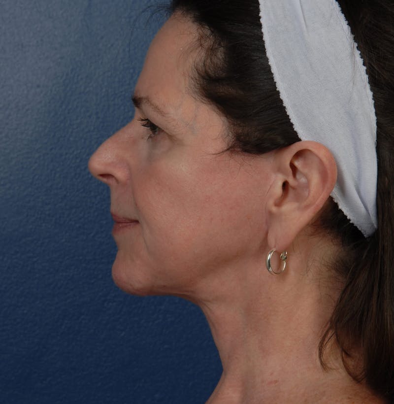 Facelift Before & After Gallery - Patient 67109688 - Image 6