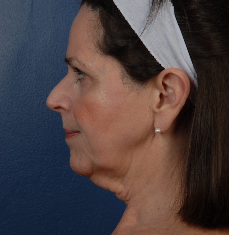 Facelift Before & After Gallery - Patient 67109688 - Image 5