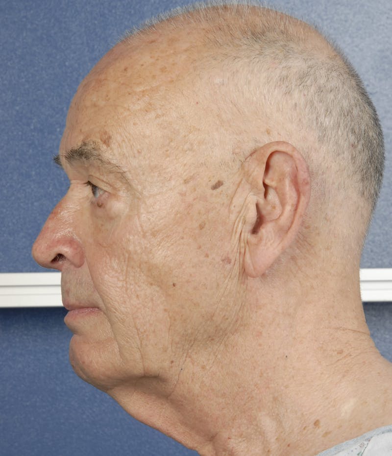 Facelift Before & After Gallery - Patient 67109779 - Image 5