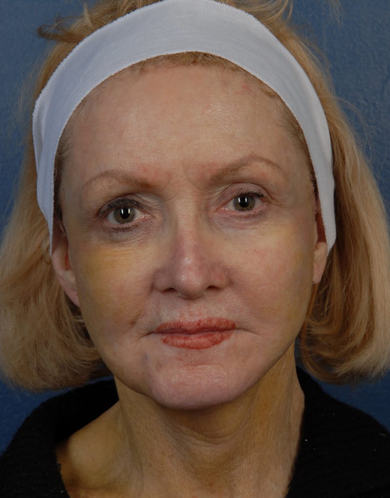 Facial Fat Grafting Before & After Gallery - Patient 67120191 - Image 2