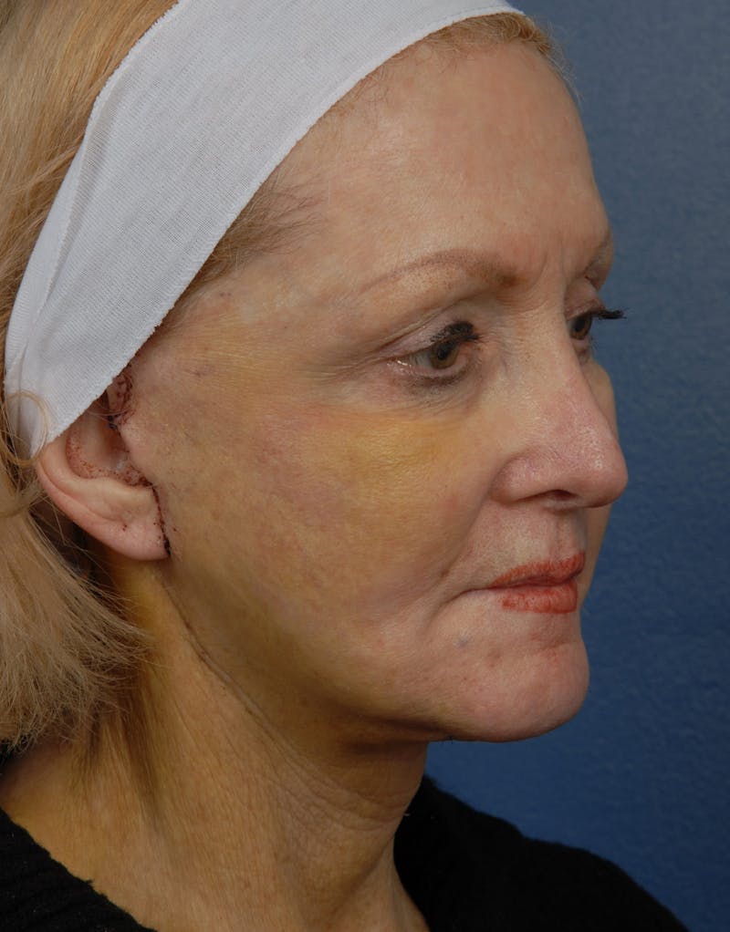 Facial Fat Grafting Before & After Gallery - Patient 67120191 - Image 4