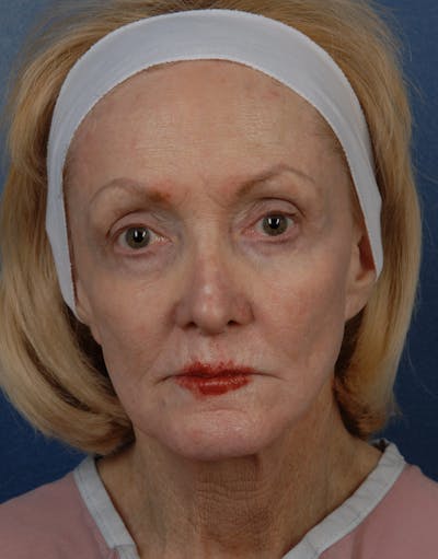 Facial Fat Grafting Before & After Gallery - Patient 67120191 - Image 1