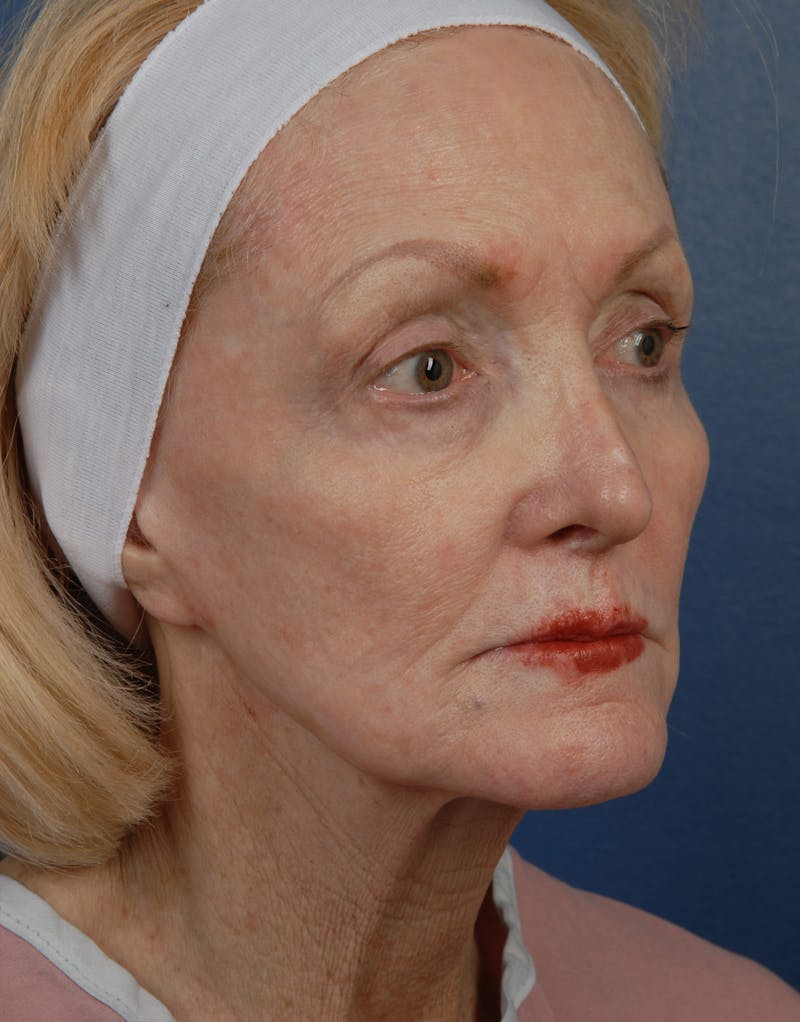 Facial Fat Grafting Before & After Gallery - Patient 67120191 - Image 3