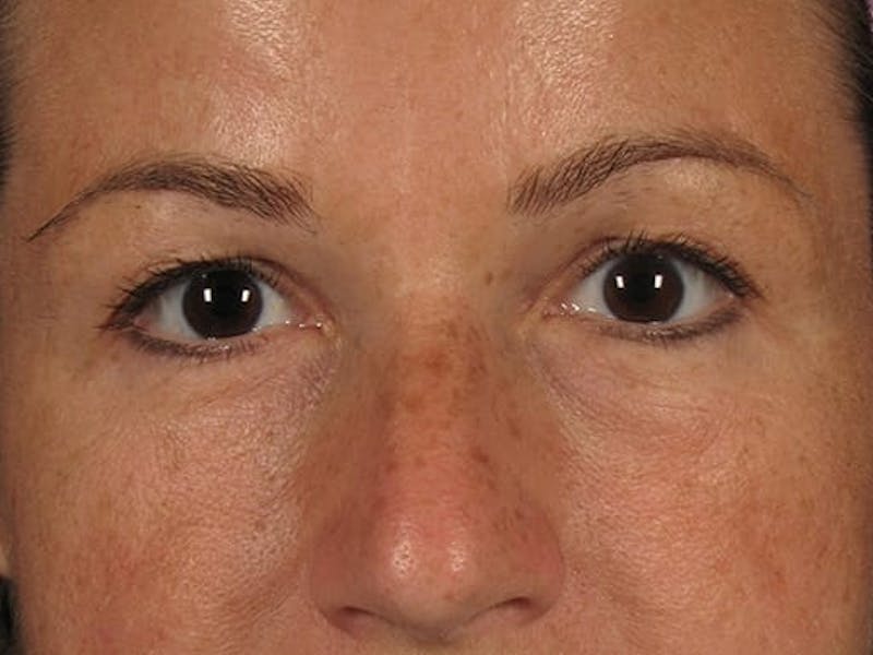 Blepharoplasty Before & After Gallery - Patient 67106810 - Image 1