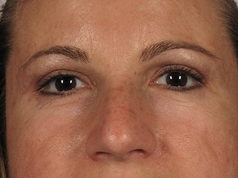 Blepharoplasty Before & After Gallery - Patient 67106810 - Image 2