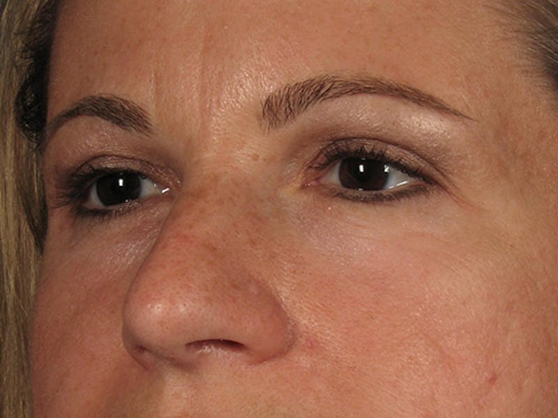Blepharoplasty Before & After Gallery - Patient 67106810 - Image 4