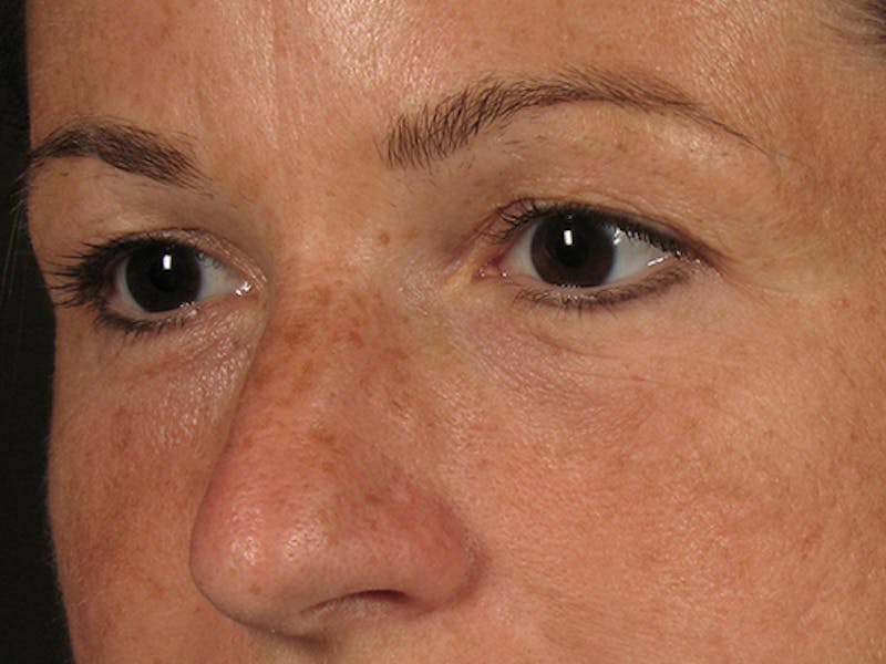 Blepharoplasty Before & After Gallery - Patient 67106810 - Image 3