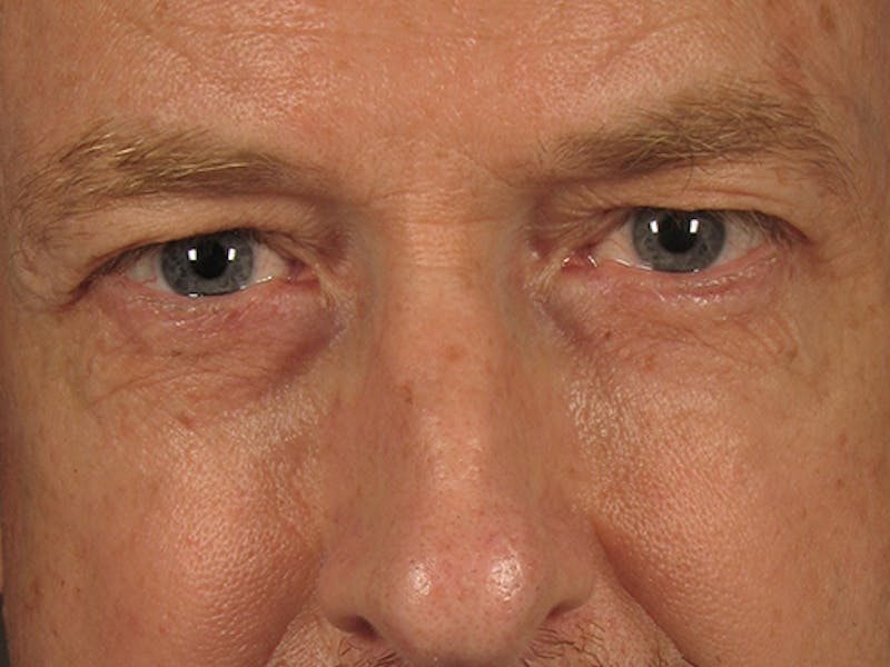 Blepharoplasty Before & After Gallery - Patient 67120222 - Image 1