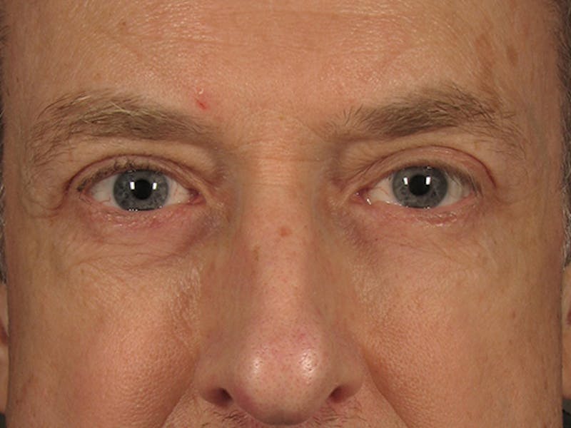 Blepharoplasty Before & After Gallery - Patient 67120222 - Image 2