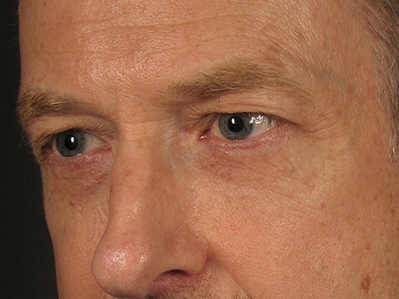 Blepharoplasty Before & After Gallery - Patient 67120222 - Image 3