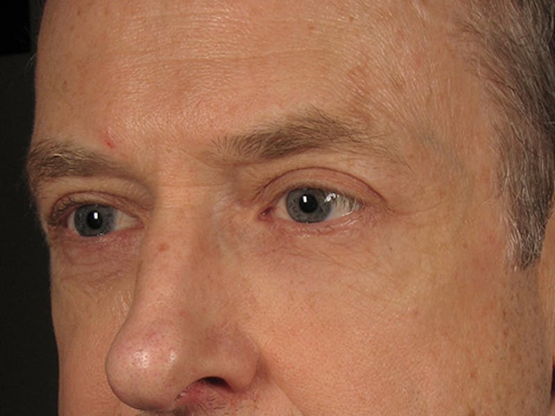Blepharoplasty Before & After Gallery - Patient 67120222 - Image 4