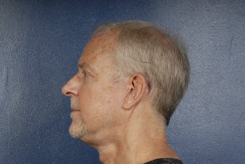 Facelift Before & After Gallery - Patient 160707 - Image 4