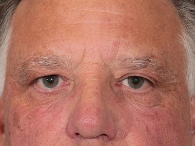 Blepharoplasty Before & After Gallery - Patient 342010 - Image 1