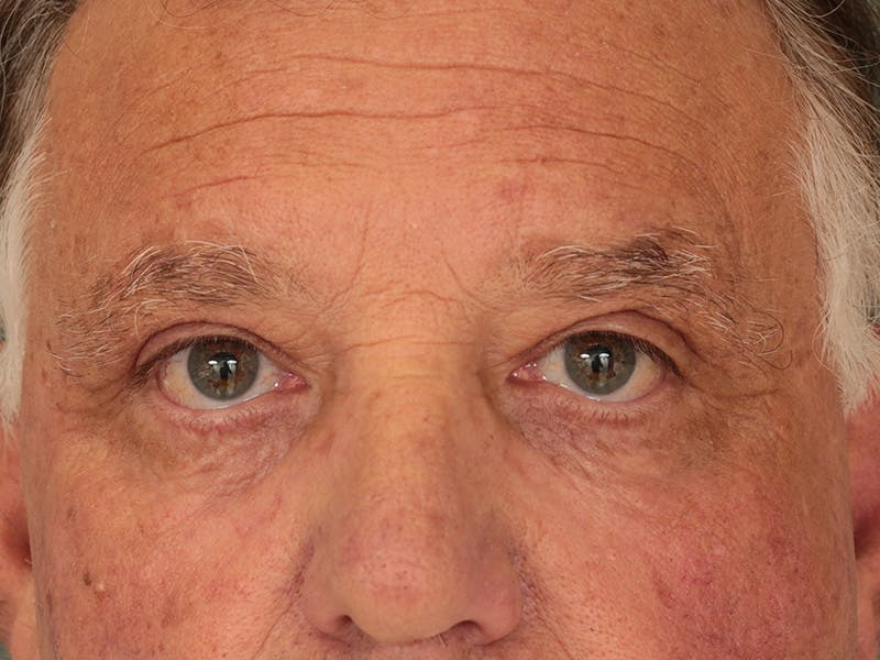 Blepharoplasty Before & After Gallery - Patient 342010 - Image 2
