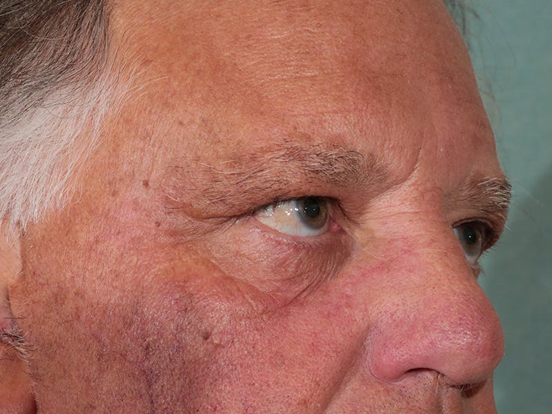 Blepharoplasty Before & After Gallery - Patient 342010 - Image 3