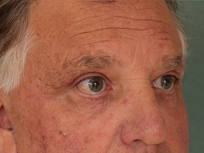 Blepharoplasty Before & After Gallery - Patient 342010 - Image 4
