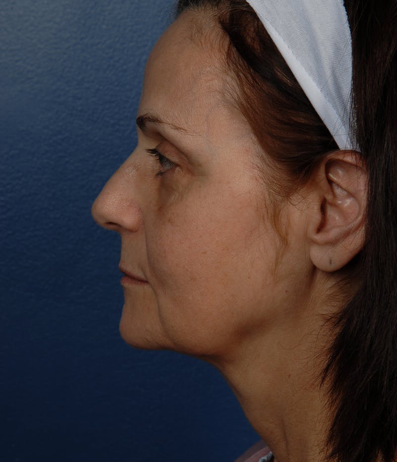 Mini Facelift Before & After Gallery - Patient 346739 - Image 5