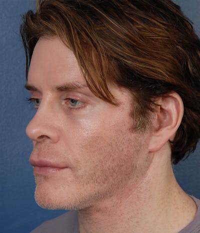 Mini Facelift Before & After Gallery - Patient 109071 - Image 2