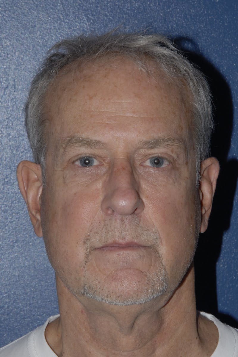 Facelift Before & After Gallery - Patient 160707 - Image 3