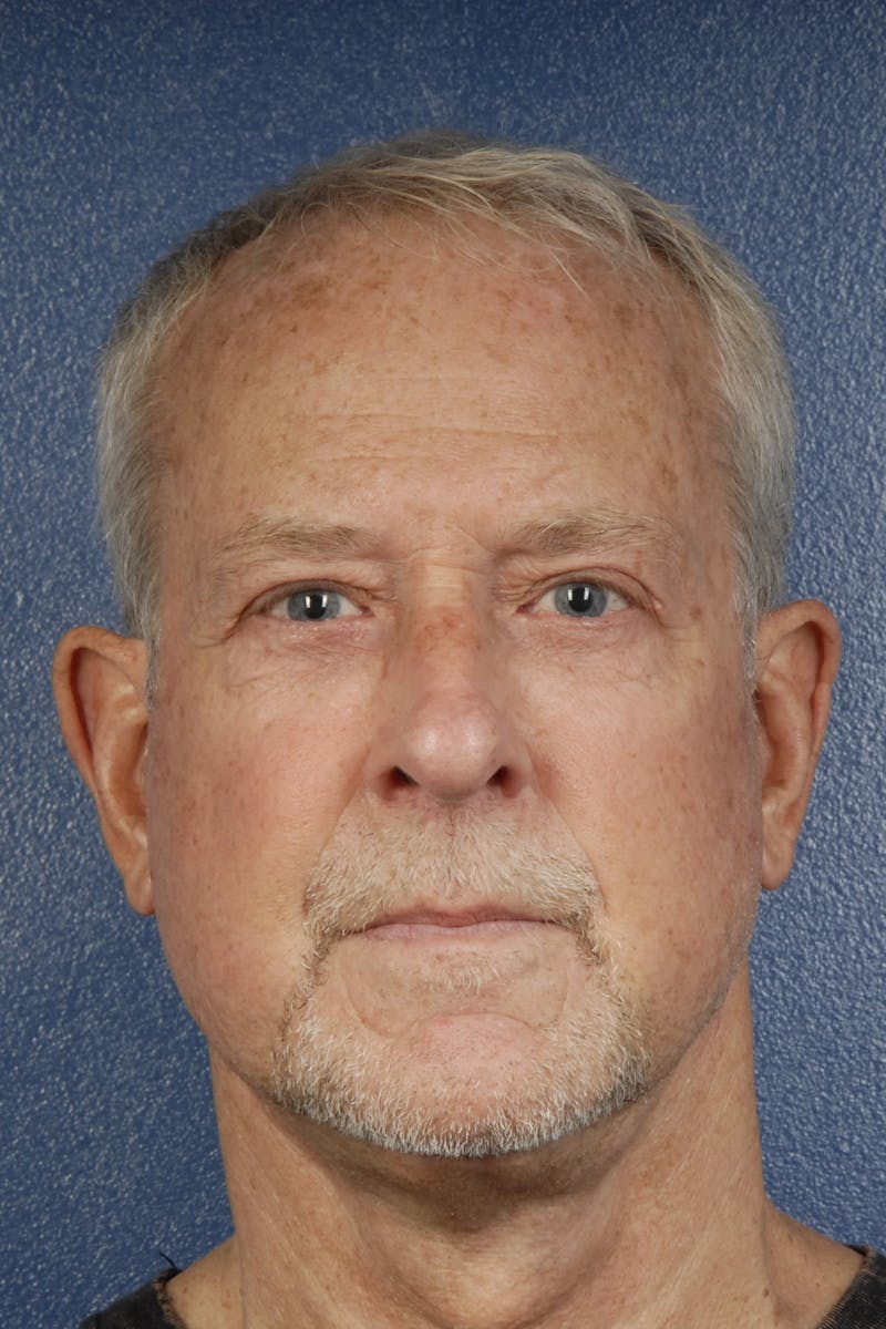 Facelift Before & After Gallery - Patient 160707 - Image 4