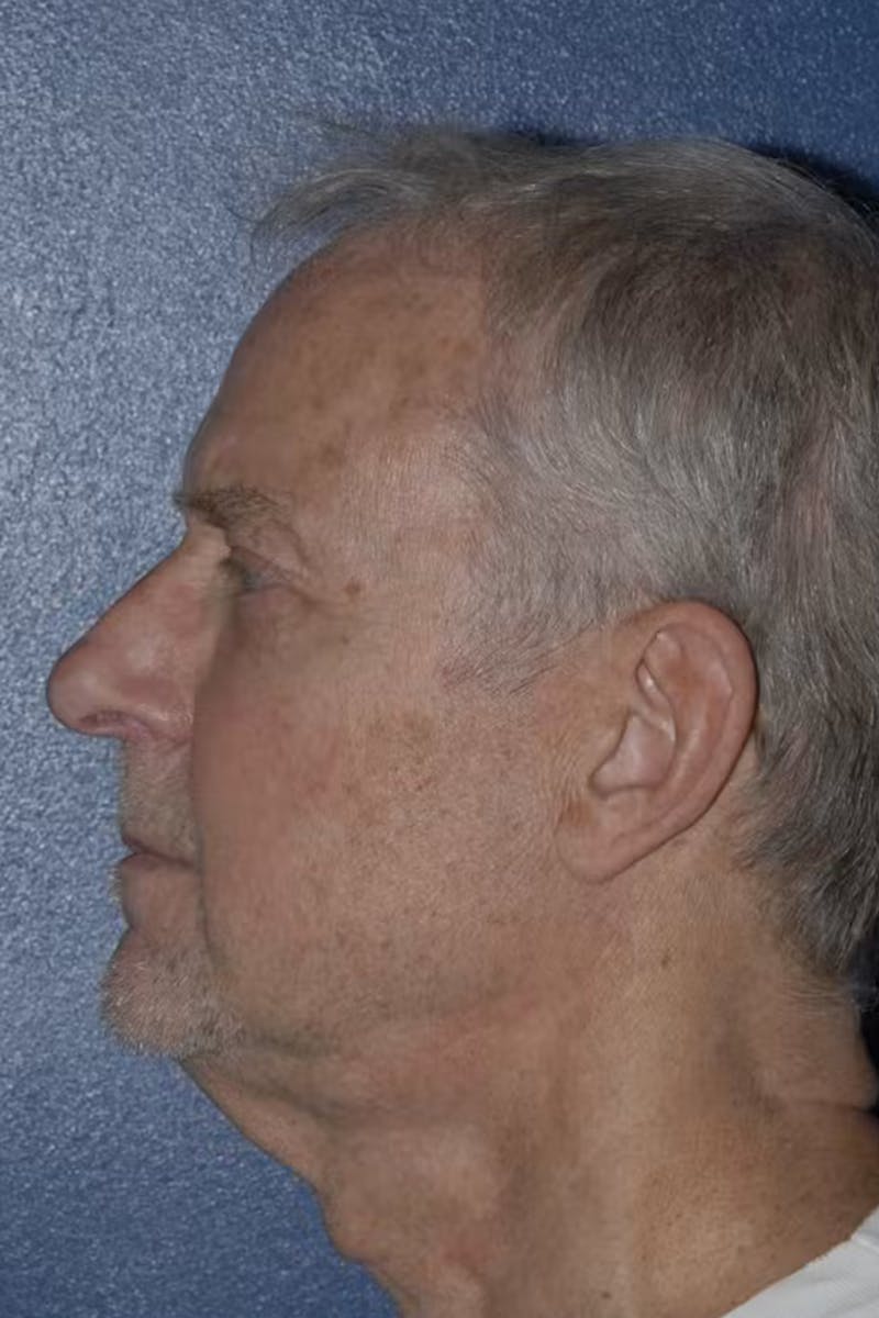 Facelift Before & After Gallery - Patient 160707 - Image 1