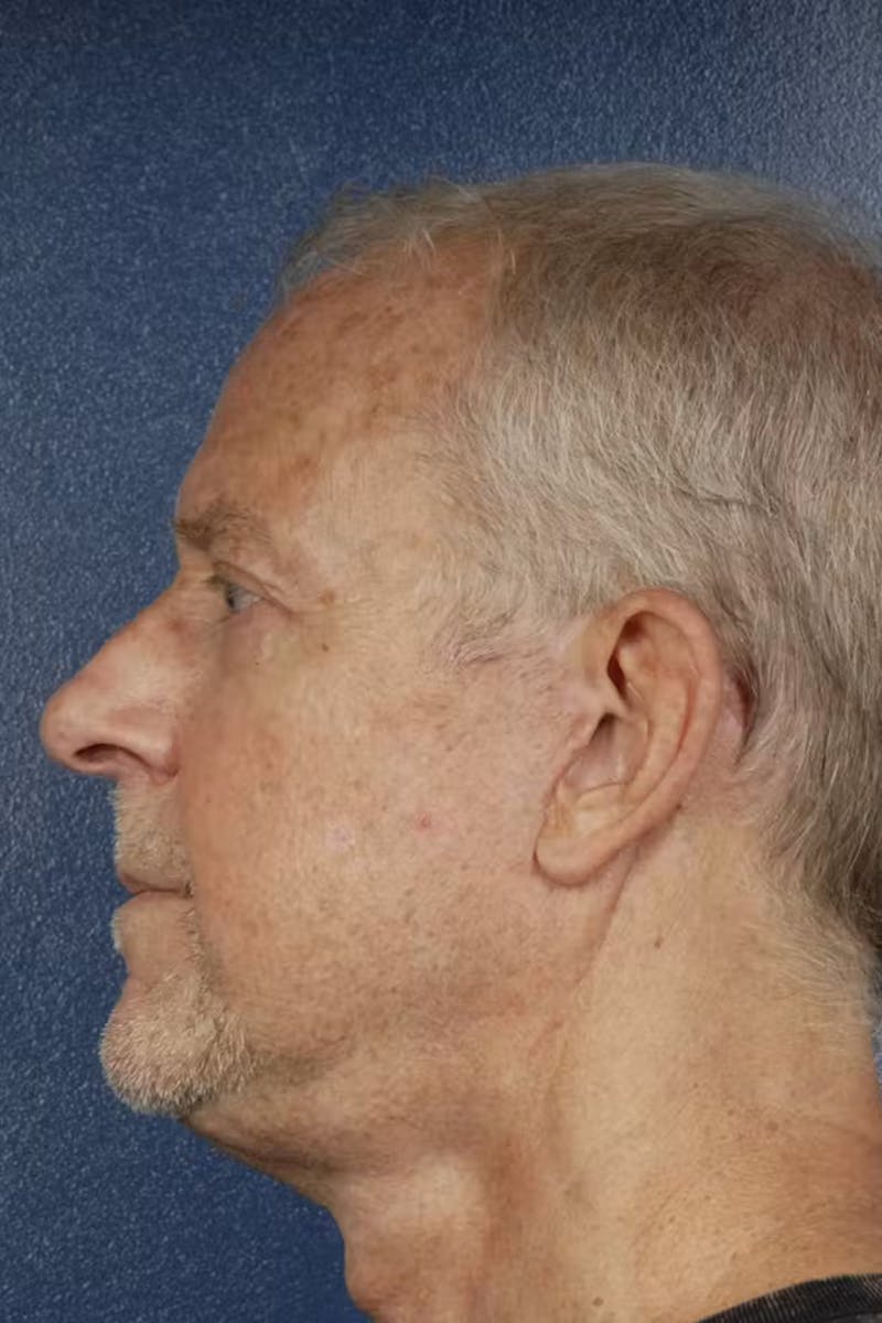 Facelift Before & After Gallery - Patient 160707 - Image 2