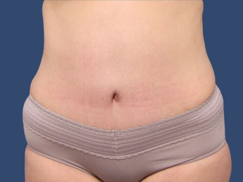 Tummy Tuck Scars after 5 years