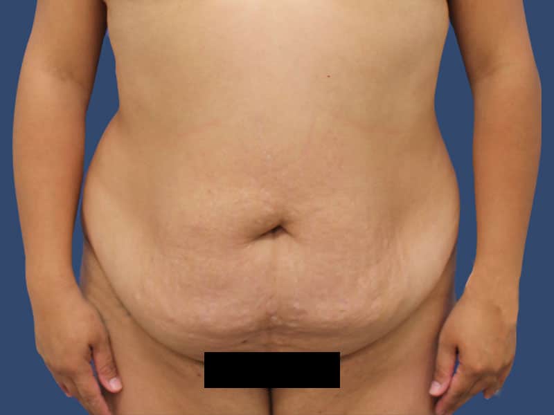 Tummy Tuck After Photo