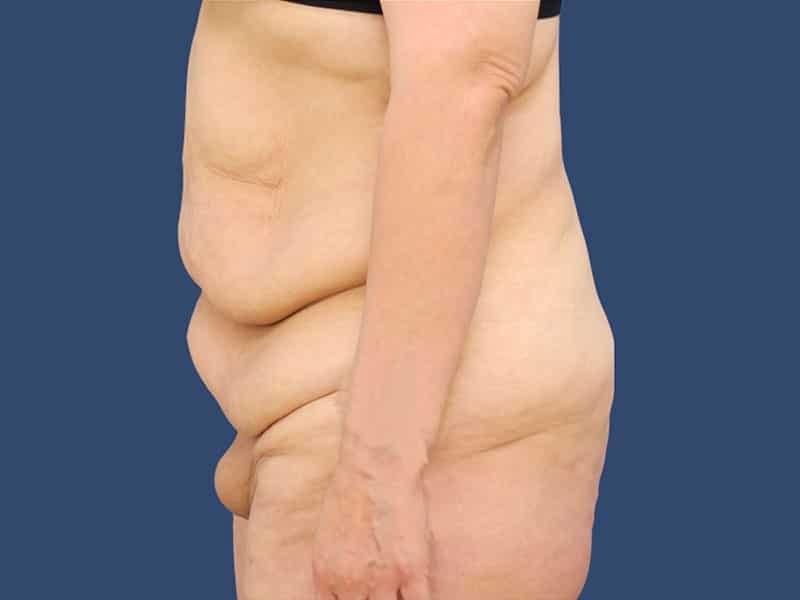 Tummy Tuck Before & After Gallery - Patient 54882387 - Image 5