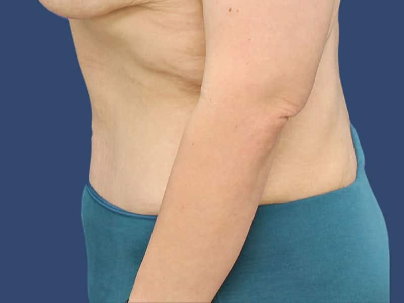 Tummy Tuck Before & After Gallery - Patient 54882387 - Image 6