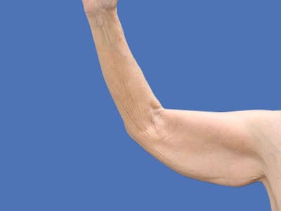 Arm Lift Before & After Gallery - Patient 54882388 - Image 1