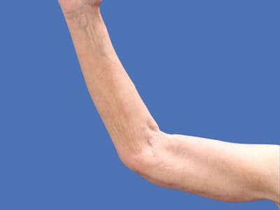 Arm Lift Before & After Gallery - Patient 54882388 - Image 2