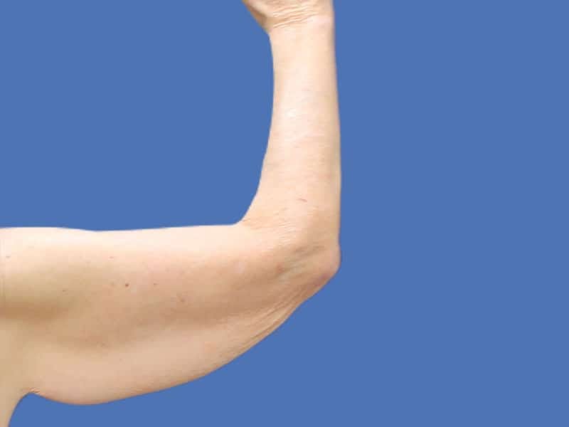 Arm Lift Before & After Gallery - Patient 54882388 - Image 3
