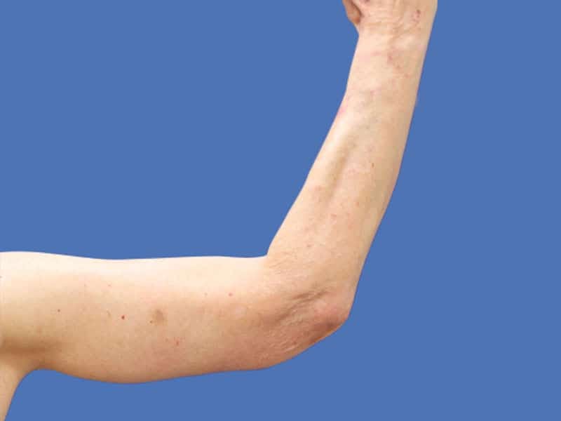 Arm Lift Before & After Gallery - Patient 54882388 - Image 4