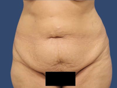 Tummy Tuck Before & After Gallery - Patient 54882391 - Image 1
