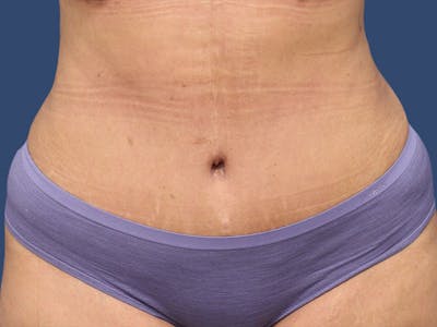 Tummy Tuck Before & After Gallery - Patient 54882391 - Image 2