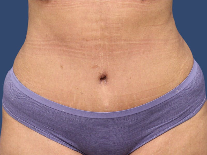 Tummy Tuck Before & After Gallery - Patient 54882391 - Image 2