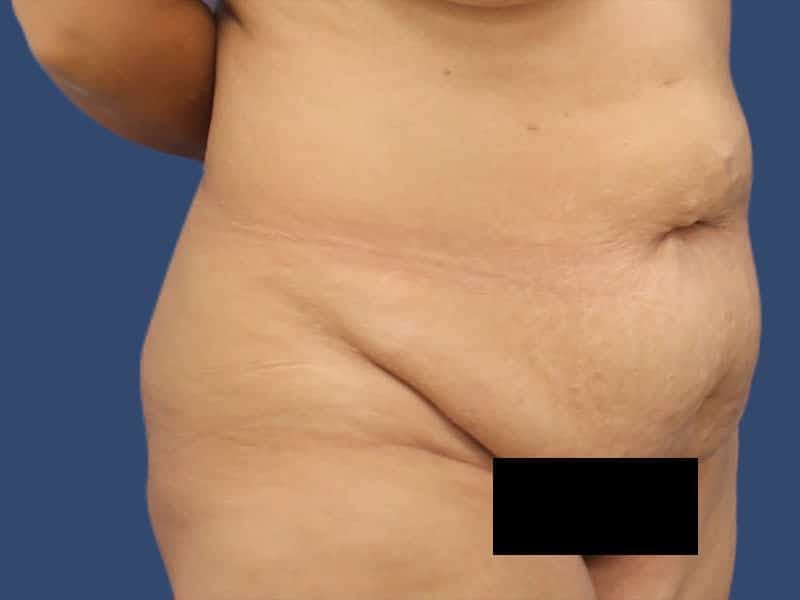 Tummy Tuck Before & After Gallery - Patient 54882391 - Image 3