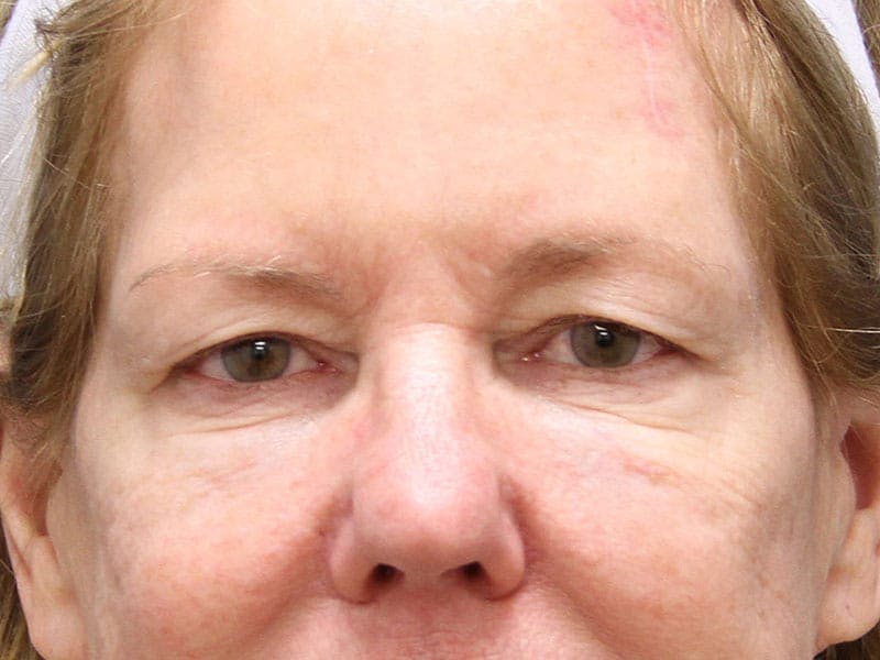 Eyelid Surgery