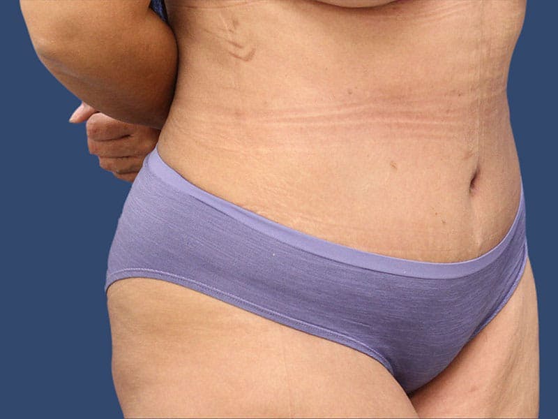 Tummy Tuck Before & After Gallery - Patient 54882391 - Image 4